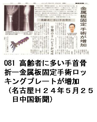 081 高齢者に多い手首骨折ー金属板固定手術ロッキングプレートが増加（名古屋Ｈ２４年５月２５日中国新聞）