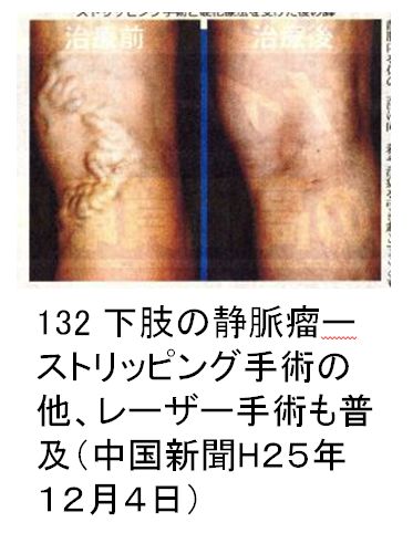 132 下肢の静脈瘤-ストリッピング手術の他、レーザー手術も普及（中国新聞H25年12月4日）